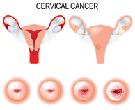 Pap Smear Misdiagnosis