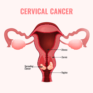 Pap Smear Misdiagnosis Attorney