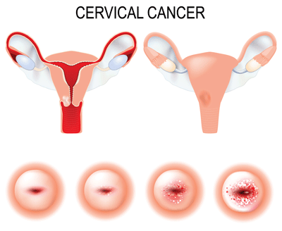Cervical Cancer Diagnosis Delay