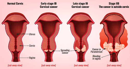 Misread Pap Test Cervical Cancer