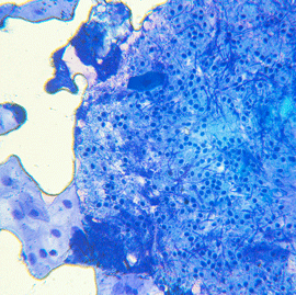 Rochester Cervical Cancer Misdiagnosis Lawsuits